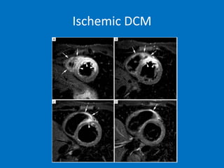 Ischemic DCM
 
