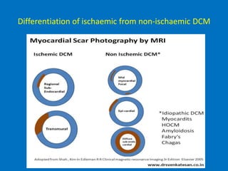 Differentiation of ischaemic from non-ischaemic DCM
 