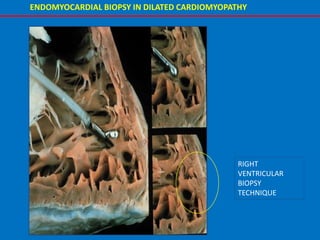 RIGHT
VENTRICULAR
BIOPSY
TECHNIQUE
ENDOMYOCARDIAL BIOPSY IN DILATED CARDIOMYOPATHY
 