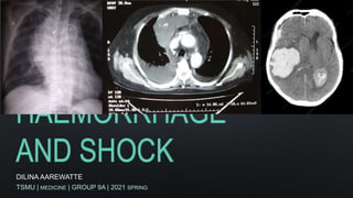 HAEMORRHAGE
AND SHOCK
DILINA AAREWATTE
TSMU | MEDICINE | GROUP 9A | 2021 SPRING
 