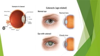 CATARACTS CASE PRESENTATION WITH DISEASE INFORMATION | PPTX