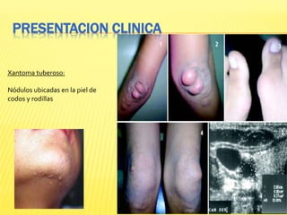Xantoma tuberoso:
Nódulos ubicadas en la piel de
codos y rodillas
PRESENTACION CLINICA
 