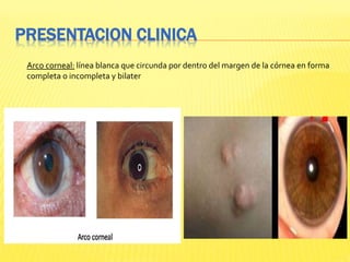 PRESENTACION CLINICA
Arco corneal: línea blanca que circunda por dentro del margen de la córnea en forma
completa o incompleta y bilater
 