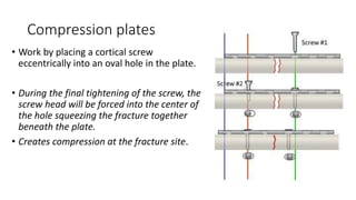 Compression Using A Plate screws and plate | PPTX