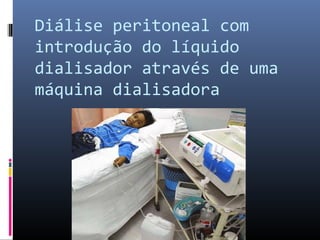 Diálise peritoneal com 
introdução do líquido 
dialisador através de uma 
máquina dialisadora 
 