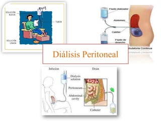 Diálisis Peritoneal
 