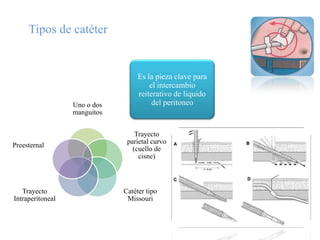 Tipos de catéter


                                   Es la pieza clave para
                                       el intercambio
                                   reiterativo de liquido
                  Uno o dos             del peritoneo
                  manguitos


                                  Trayecto
                               parietal curvo
Preesternal
                                 (cuello de
                                   cisne)



   Trayecto                   Catéter tipo
Intraperitoneal                Missouri
 