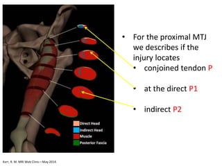 Kerr, R. M. MRI Web Clinic—May 2014.
• For the proximal MTJ
we describes if the
injury locates
• conjoined tendon P
• at the direct P1
• indirect P2
 