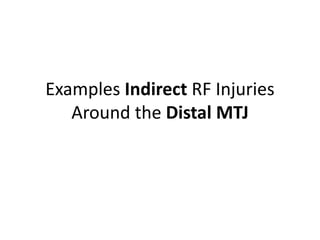 Examples Indirect RF Injuries
Around the Distal MTJ
 