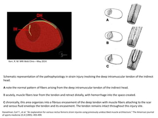 Hasselman, Carl T., et al. "An explanation for various rectus femoris strain injuries using previously undescribed muscle architecture." The American journal
of sports medicine 23.4 (1995): 493-499.
Schematic representation of the pathophysiology in strain injury involving the deep intramuscular tendon of the indirect
head.
A note the normal pattern of fibers arising from the deep intramuscular tendon of the indirect head.
B acutely, muscle fibers tear from the tendon and retract distally, with hemorrhage into the space created.
C chronically, this area organizes into a fibrous encasement of the deep tendon with muscle fibers attaching to the scar
and serous fluid envelops the tendon and its encasement. The tendon remains intact throughout this injury site.
Kerr, R. M. MRI Web Clinic—May 2014.
 