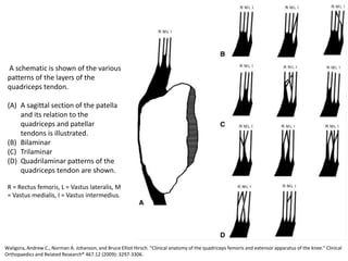 Waligora, Andrew C., Norman A. Johanson, and Bruce Elliot Hirsch. "Clinical anatomy of the quadriceps femoris and extensor apparatus of the knee." Clinical
Orthopaedics and Related Research® 467.12 (2009): 3297-3306.
A schematic is shown of the various
patterns of the layers of the
quadriceps tendon.
(A) A sagittal section of the patella
and its relation to the
quadriceps and patellar
tendons is illustrated.
(B) Bilaminar
(C) Trilaminar
(D) Quadrilaminar patterns of the
quadriceps tendon are shown.
R = Rectus femoris, L = Vastus lateralis, M
= Vastus medialis, I = Vastus intermedius.
 