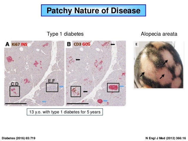 Similarities Between Type 1 Diabetes And Alopecia Areata