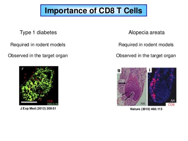 Similarities Between Type 1 Diabetes And Alopecia Areata