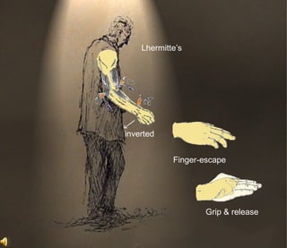 Lhermitte’s




inverted


            Finger-escape




                    Grip & release
 