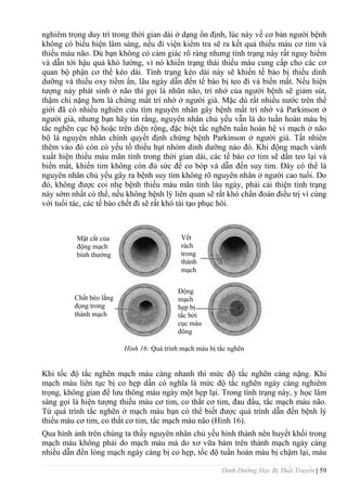 Dinh Dưỡng Học Bị Thất Truyền | 59
nghiêm trọng duy trì trong thời gian dài ở dạng ổn định, lúc này về cơ bản ngƣời bệnh
không có biểu hiện lâm sàng, nếu đi viện kiểm tra sẽ ra kết quả thiếu máu cơ tim và
thiếu máu não. Dù bạn không có cảm giác rõ ràng nhƣng tình trạng này rất nguy hiểm
và dẫn tới hậu quả khó lƣờng, vì nó khiến trạng thái thiếu máu cung cấp cho các cơ
quan bộ phận cơ thể kéo dài. Tình trạng kéo dài này sẽ khiến tế bào bị thiếu dinh
dƣỡng và thiếu oxy tiềm ẩn, lâu ngày dẫn đến tế bào bị teo đi và biến mất. Nếu hiện
tƣợng này phát sinh ở não thì gọi là nhũn não, trí nhớ của ngƣời bệnh sẽ giảm sút,
thậm chí nặng hơn là chứng mất trí nhớ ở ngƣời già. Mặc dù rất nhiều nƣớc trên thế
giới đã có nhiều nghiên cứu tìm nguyên nhân gây bệnh mất trí nhớ và Parkinson ở
ngƣời già, nhƣng bạn hãy tin rằng, nguyên nhân chủ yếu vẫn là do tuần hoàn máu bị
tắc nghẽn cục bộ hoặc trên diện rộng, đặc biệt tắc nghẽn tuần hoàn hệ vi mạch ở não
bộ là nguyên nhân chính quyết định chứng bệnh Parkinson ở ngƣời già. Tất nhiên
thêm vào đó còn có yếu tố thiếu hụt nhóm dinh dƣỡng nào đó. Khi động mạch vành
xuất hiện thiếu máu mãn tính trong thời gian dài, các tế bào cơ tim sẽ dần teo lại và
biến mất, khiến tim không còn đủ sức để co bóp và dẫn đến suy tim. Đây có thể là
nguyên nhân chủ yếu gây ra bệnh suy tim không rõ nguyên nhân ở ngƣời cao tuổi. Do
đó, không đƣợc coi nhẹ bệnh thiếu máu mãn tính lâu ngày, phải cải thiện tình trạng
này sớm nhất có thể, nếu không bệnh lý liên quan sẽ rất khó chẩn đoán điều trị vì cùng
với tuổi tác, các tế bào chết đi sẽ rất khó tái tạo phục hôi.
Hình 16: Quá trình mạch máu bị tắc nghẽn
Khi tốc độ tắc nghẽn mạch máu càng nhanh thì mức độ tắc nghẽn càng nặng. Khi
mạch máu liên tục bị co hẹp dần có nghĩa là mức độ tắc nghẽn ngày càng nghiêm
trọng, không gian để lƣu thông máu ngày một hẹp lại. Trong tình trạng này, y học lâm
sàng gọi là hiện tƣợng thiếu máu cơ tim, co thắt cơ tim, đau đầu, tắc mạch máu não.
Từ quá trình tắc nghẽn ở mạch máu bạn có thể biết đƣợc quá trình dẫn đến bệnh lý
thiếu máu cơ tim, co thắt cơ tim, tắc mạch máu não (Hình 16).
Qua hình ảnh trên chúng ta thấy nguyên nhân chủ yếu hình thành nên huyết khối trong
mạch máu không phải do mạch máu mà do xơ vữa bám trên thành mạch ngày càng
nhiều dẫn đến lòng mạch ngày càng bị co hẹp, tốc độ tuần hoàn máu bị chậm lại, máu
Mặt cắt của
động mạch
bình thƣờng
Chất béo lắng
đọng trong
thành mạch
Vết
rách
trong
thành
mạch
Động
mạch
hẹp bị
tắc bởi
cục máu
đông
 