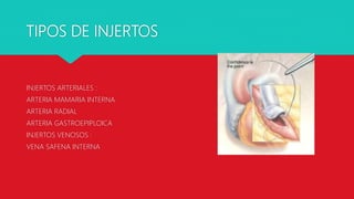 TIPOS DE INJERTOS
INJERTOS ARTERIALES :
ARTERIA MAMARIA INTERNA
ARTERIA RADIAL
ARTERIA GASTROEPIPLOICA
INJERTOS VENOSOS :
VENA SAFENA INTERNA
 