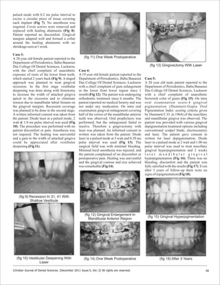 pulsed mode with 0.2 ms pulse interval to
excise a circular piece of tissue covering
each implant (Fig 7). No anesthesia was
required. Cover screws were removed and
replaced with healing abutments (Fig 8).
Patient reported no discomfort. Gingival
margins adapted well and formed a collar
around the healing abutments with no
shrinkageseenat1week.
Case 3:
A 20 year old female patient reported to the
Department of Periodontics, Babu Banarasi
Das College Of Dental Sciences, Lucknow,
with the chief complaint of unaesthetic
exposure of roots of the lower front teeth,
which started 2 years back (Fig 9). A staged
approach was planned to treat gingival
recession. In the first stage vestibular
deepening was done along with frenotomy
to increase the width of attached gingiva
apical to the recession and to eliminate
tension due to mandibular labial frenum on
the gingival margins. Recession coverage
was planned to be done in the second stage.
A written informed consent was taken from
the patient. Diode laser at a pulsed mode, 2
watt & 1.0 ms pulse interval was used (Fig
10). The procedure was performed with no
patient discomfort or pain. Anesthesia was
not required. The healing was uneventful
and a gain in the width of attached gingiva
could be appreciated after vestibular
deepening(Fig11).
Case 4:
A 19 year old female patient reported to the
Department of Periodontics, Babu Banarasi
Das College Of Dental Sciences, Lucknow
with a chief complaint of gum enlargement
in the lower front lower region since 1
month (Fig 12). The patient was undergoing
orthodontic treatment since 6 months. The
patient reported no medical history and was
not under any medication. On intra oral
examination gingival enlargement covering
half of the crown of the mandibular anterior
teeth was observed. Oral prophylaxis was
performed, but the enlargement failed to
resolve. Therefore a gingivectomy with
laser was planned. An informed consent in
written was taken from the patient. Diode
laser in a pulsed mode at 5 watt and 0.20 ms
pulse interval was used (Fig 13). The
surgical field was with minimal bleeding.
Minimal local anesthesia was injected, and
the patient complained of no discomfort or
postoperative pain. Healing was uneventful
and the gingival contour and size achieved
was remarkable(Fig14)
Case 5:
A 20 year old male patient reported to the
Department of Periodontics, Babu Banarasi
Das College Of Dental Sciences, Lucknow
with a chief complaint of unaesthetic
brownish color of gums (Fig 15). On intra
oral examination score-4 gingival
pigmentation (Dummett-Gupta Oral
Pigmentation Index scoring criteria given
by Dummett C.O. in 1964) of the maxillary
and mandibular gingiva was observed. The
patient was provided with various gingival
depigmentation treatment options including
conventional scalpel blade, electrocautery
and laser. The patient gave consent in
written for laser depigmentation. Diode
laser in a pulsed mode at 2 watt and 1.00 ms
pulse interval was used to treat maxillary
gingival hyperpigmentation and 2 weeks
l a t e r m a n d i b u l a r g i n g i v a l
hyperpigmentation (Fig 16). There was no
bleeding, discomfort and the patient was
fully satisfied with the results (Fig 17). Even
after 3 years of follow-up there were no
signs ofrepigmentation(Fig18).
66©Indian Journal of Dental Sciences. (December 2011 Issue:5, Vol.:3) All rights are reserved.
(fig 9) Recession In 31, 41 With
Shallow Vestibule
(fig 11) One Week Postoperative
(fig 10) Vestibular Deepening With
Laser
(fig 14) One Week Postoperative
(fig 13) Gingivectomy With Laser
(fig 12) Gingival Enlargement In
Mandibular Anterior Region
(fig 15) Gingival Hyperpigmentation
(fig 18) After 3 Years
 