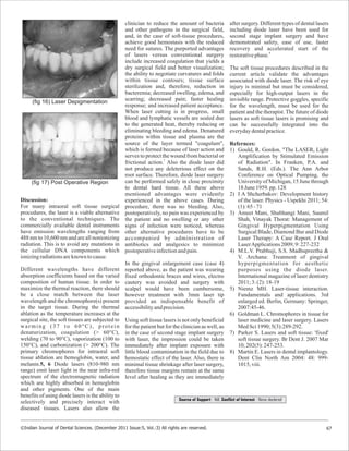 Discussion:
For many intraoral soft tissue surgical
procedures, the laser is a viable alternative
to the conventional techniques. The
commercially available dental instruments
have emission wavelengths ranging from
488 nm to 10,600 nm and are all nonionizing
radiation. This is to avoid any mutations in
the cellular DNA components which
ionizingradiationsareknown tocause.
Different wavelengths have different
absorption coefficients based on the varied
composition of human tissue. In order to
maximize the thermal reaction, there should
be a close match between the laser
wavelength and the chromophore(s) present
in the target tissue. During the thermal
ablation as the temperature increases at the
surgical site, the soft tissues are subjected to
warming (37 to 60°C), protein
denaturization, coagulation (> 60°C),
welding (70 to 90°C), vaporization (100 to
150°C), and carbonization (> 200°C). The
primary chromophores for intraoral soft
tissue ablation are hemoglobin, water, and
melanin.5, 6 Diode lasers (810-980 nm
range) emit laser light in the near infra-red
spectrum of the electromagnetic radiation
which are highly absorbed in hemoglobin
and other pigments. One of the main
benefits of using diode lasers is the ability to
selectively and precisely interact with
diseased tissues. Lasers also allow the
clinician to reduce the amount of bacteria
and other pathogens in the surgical field,
and, in the case of soft-tissue procedures,
achieve good hemostasis with the reduced
need for sutures. The purported advantages
of lasers versus conventional surgery
include increased coagulation that yields a
dry surgical field and better visualization;
the ability to negotiate curvatures and folds
within tissue contours; tissue surface
sterilization and, therefore, reduction in
bacteremia; decreased swelling, edema, and
scarring; decreased pain; faster healing
response; and increased patient acceptance.
When laser cutting is in progress, small
blood and lymphatic vessels are sealed due
to the generated heat, thereby reducing or
eliminating bleeding and edema. Denatured
proteins within tissue and plasma are the
source of the layer termed "coagulum",
which is formed because of laser action and
serves to protect the wound from bacterial or
7
frictional action. Also the diode laser did
not produce any deleterious effect on the
root surface. Therefore, diode laser surgery
can be performed safely in close proximity
to dental hard tissue. All these above
mentioned advantages were evidently
experienced in the above cases. During
procedure, there was no bleeding. Also,
postoperatively, no pain was experienced by
the patient and no swelling or any other
signs of infection were noticed, whereas
other alternative procedures have to be
accompanied by administration of
antibiotics and analgesics to minimize
postoperativeinfectionandpain.
In the gingival enlargement case (case 4)
reported above, as the patient was wearing
fixed orthodontic braces and wires, electro
cautery was avoided and surgery with
scalpel would have been cumbersome,
however treatment with 3mm laser tip
provided an indispensable benefit of
accessibilityandprecision.
Using soft tissue lasers is not only beneficial
for the patient but for the clinician as well, as
in the case of second stage implant surgery
with laser, the impression could be taken
immediately after implant exposure with
little blood contamination in the field due to
hemostatic effect of the laser. Also, there is
minimal tissue shrinkage after laser surgery,
therefore tissue margins remain at the same
level after healing as they are immediately
after surgery. Different types of dental lasers
including diode laser have been used for
second stage implant surgery and have
demonstrated safety, ease of use, faster
recovery and accelerated start of the
8
restorativephase.
The soft tissue procedures described in the
current article validate the advantages
associated with diode laser. The risk of eye
injury is minimal but must be considered,
especially for high-output lasers in the
invisible range. Protective goggles, specific
for the wavelength, must be used for the
patient and the therapist. The future of diode
lasers as soft tissue lasers is promising and
can be successfully integrated into the
everydaydentalpractice.
Refernces:
1) Gould, R. Gordon. "The LASER, Light
Amplification by Stimulated Emission
of Radiation". In Franken, P.A. and
Sands, R.H. (Eds.). The Ann Arbor
Conference on Optical Pumping, the
University of Michigan, 15 June through
18June1959.pp.128
2) I A Shcherbakov: Development history
of the laser. Physics - Uspekhi 2011; 54:
(1):65-71
3) Ameet Mani, Shubhangi Mani, Saumil
Shah, Vinayak Thorat: Management of
Gingival Hyperpigmentation Using
Surgical Blade, Diamond Bur and Diode
Laser Therapy: A Case Report. J Oral
LaserApplications2009;9:227-232
4) M.L.V. Prabhuji, S.S. Madhupreetha &
V. Archana: Treatment of gingival
hyperpigmentation for aesthetic
purposes using the diode laser.
International magazine of laser dentistry
2011;3:(2):18-19
5) Niemz MH. Laser-tissue interaction.
Fundamentals and applications. 3rd
enlarged ed. Berlin, Germany: Springer,
2007:45-46.
6) Goldman L. Chromophores in tissue for
laser medicine and laser surgery. Lasers
MedSci1990;5(3):289-292.
7) Parker S. Lasers and soft tissue: 'fixed'
soft tissue surgery. Br Dent J. 2007 Mar
10;202(5):247-253.
8) Martin E. Lasers in dental implantology.
Dent Clin North Am 2004: 48: 999-
1015,viii.
67©Indian Journal of Dental Sciences. (December 2011 Issue:5, Vol.:3) All rights are reserved.
Source of Support : Nill, Conflict of Interest : None declared
(fig 17) Post Operative Region
(fig 16) Laser Depigmentation
 