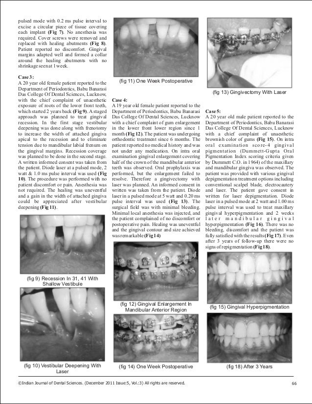 Diode laser applications in periodontics