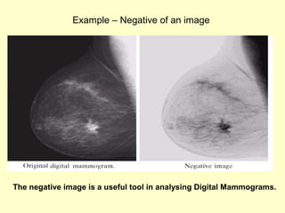 Example – Negative of an image

The negative image is a useful tool in analysing Digital Mammograms.

 