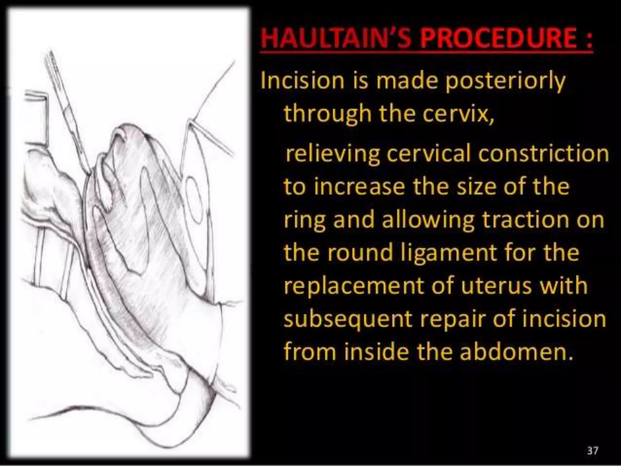 Inversion Of Uterus | PPTX