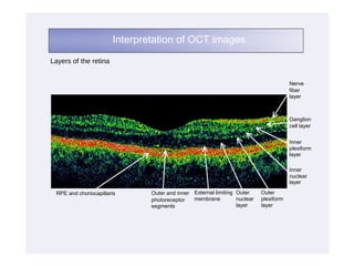 Interpretation of OCT images
Layers of the retina


                                                                                       Nerve
                                                                                       fiber
                                                                                       layer



                                                                                       Ganglion
                                                                                       cell layer


                                                                                       Inner
                                                                                       plexiform
                                                                                       layer

                                                                                       Inner
                                                                                       nuclear
                                                                                       layer

 RPE and choriocapillaris      Outer and inner External limiting Outer     Outer
                               photoreceptor   membrane          nuclear   plexiform
                               segments                          layer     layer
 