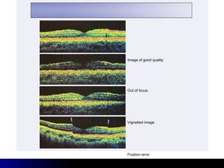 Image of good quality




Out of focus




Vignetted image




Fixation error
 