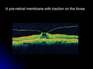 A pre-retinal membrane with traction on the fovea
 