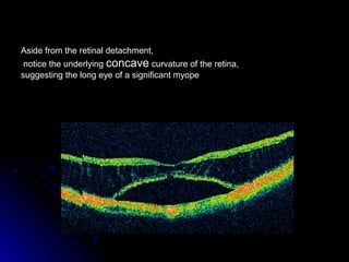 Aside from the retinal detachment,
 notice the underlying concave curvature of the retina,
suggesting the long eye of a significant myope
 