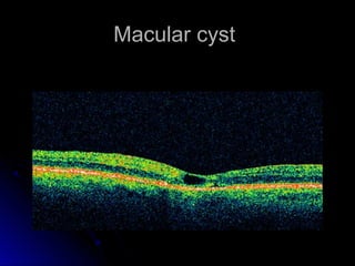 Macular cyst
 