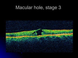 Macular hole, stage 3
 