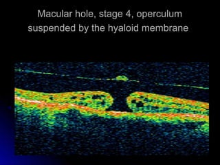 Macular hole, stage 4, operculum
suspended by the hyaloid membrane
 