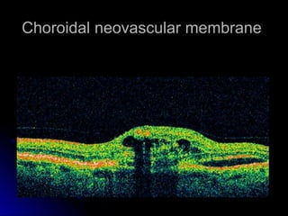 Choroidal neovascular membrane
 