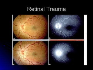 Retinal Trauma
 
