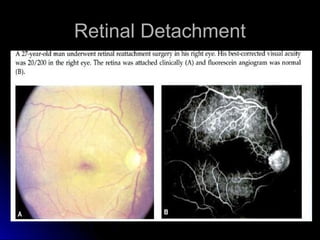 Retinal Detachment
 