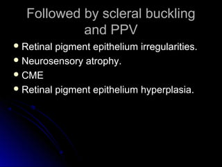 Followed by scleral buckling
            and PPV
 Retinal pigment epithelium irregularities.
 Neurosensory atrophy.
 CME
 Retinal pigment epithelium hyperplasia.
 