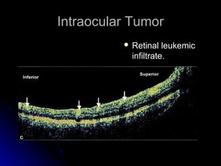 Intraocular Tumor
           Retinal   leukemic
            infiltrate.
 