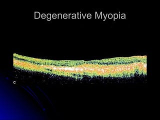 Degenerative Myopia
 