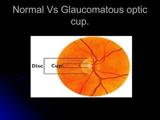 Normal Vs Glaucomatous optic
            cup.
 