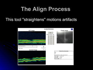 The Align Process
This tool "straightens" motions artifacts
 
