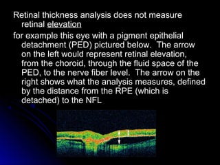 Retinal thickness analysis does not measure
  retinal elevation
for example this eye with a pigment epithelial
  detachment (PED) pictured below. The arrow
  on the left would represent retinal elevation,
  from the choroid, through the fluid space of the
  PED, to the nerve fiber level. The arrow on the
  right shows what the analysis measures, defined
  by the distance from the RPE (which is
  detached) to the NFL
 