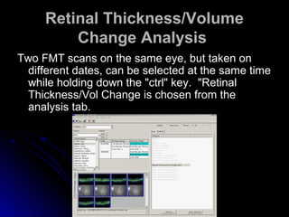 Retinal Thickness/Volume
         Change Analysis
Two FMT scans on the same eye, but taken on
 different dates, can be selected at the same time
 while holding down the "ctrl" key. "Retinal
 Thickness/Vol Change is chosen from the
 analysis tab.
 