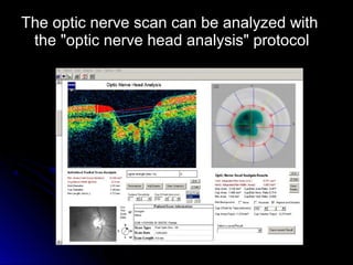 The optic nerve scan can be analyzed with
 the "optic nerve head analysis" protocol
 