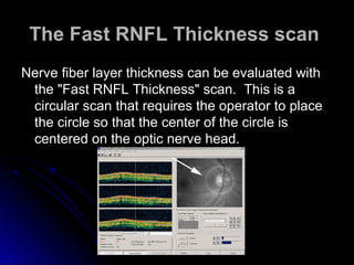 The Fast RNFL Thickness scan
Nerve fiber layer thickness can be evaluated with
 the "Fast RNFL Thickness" scan. This is a
 circular scan that requires the operator to place
 the circle so that the center of the circle is
 centered on the optic nerve head.
 
