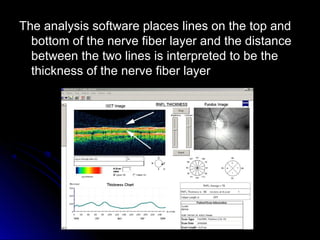 The analysis software places lines on the top and
  bottom of the nerve fiber layer and the distance
  between the two lines is interpreted to be the
  thickness of the nerve fiber layer
 