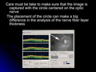 Care must be take to make sure that the image is
 captured with the circle centered on the optic
 nerve
The placement of the circle can make a big
 difference in the analysis of the nerve fiber layer
 thickness
 