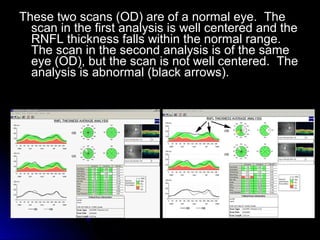 These two scans (OD) are of a normal eye. The
  scan in the first analysis is well centered and the
  RNFL thickness falls within the normal range.
  The scan in the second analysis is of the same
  eye (OD), but the scan is not well centered. The
  analysis is abnormal (black arrows).
 