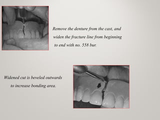 Remove the denture from the cast, and
widen the fracture line from beginning
to end with no. 558 bur.
Widened cut is beveled outwards
to increase bonding area.
 