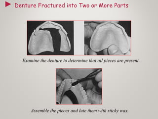► Denture Fractured into Two or More Parts
Examine the denture to determine that all pieces are present.
Assemble the pieces and lute them with sticky wax.
 