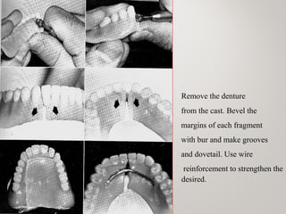 Remove the denture
from the cast. Bevel the
margins of each fragment
with bur and make grooves
and dovetail. Use wire
reinforcement to strengthen the
desired region desired.
www.indiandentalacademy.com
 